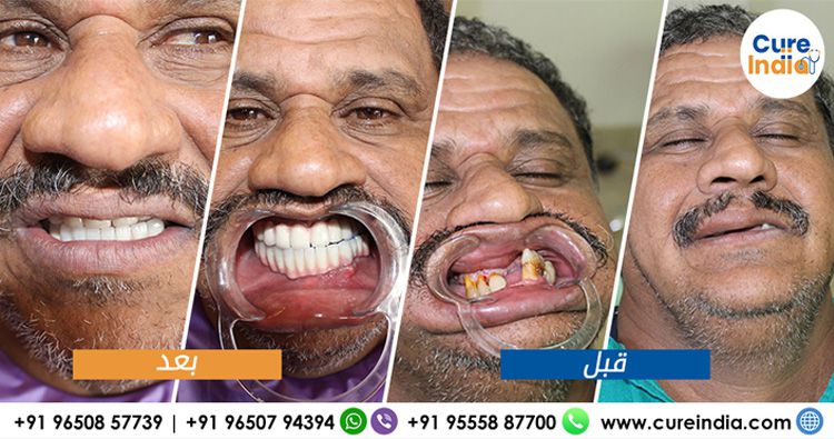 شهادات المرض لزراعة الاسنان الفورية